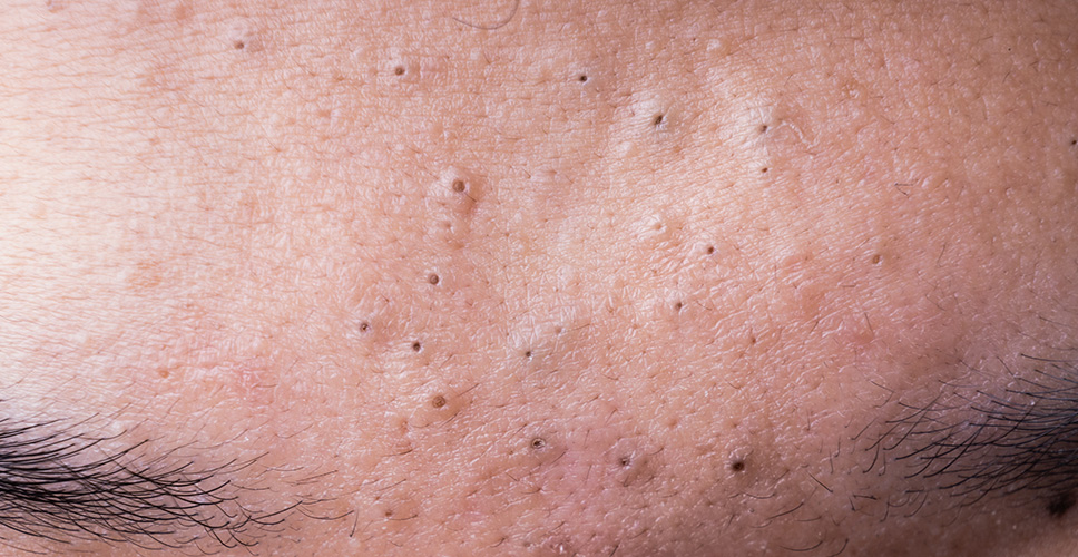 Acne Blackheads 1 - Anova Skin Clinic