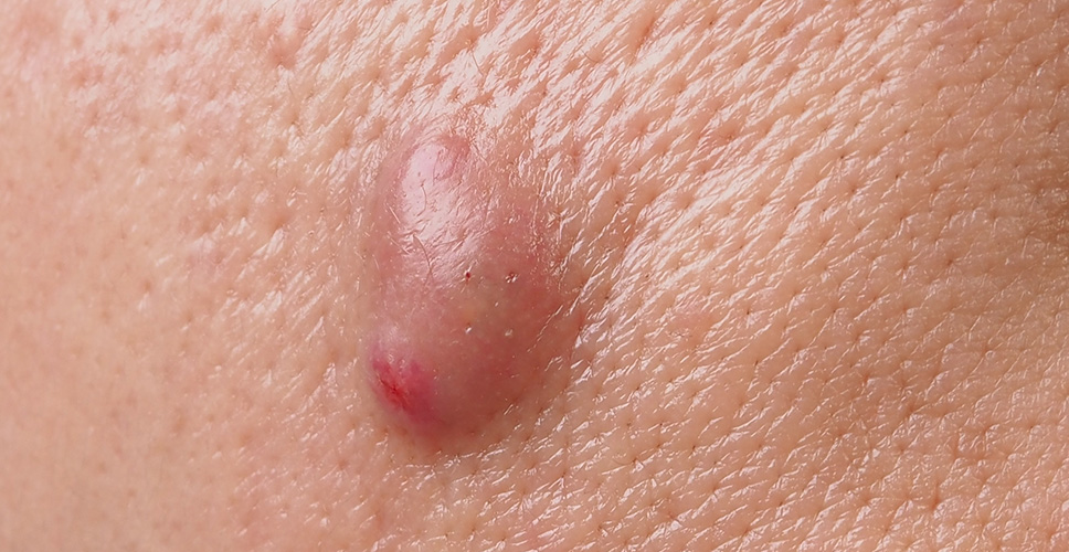 Acne Nodules 1 - Anova Skin Clinic