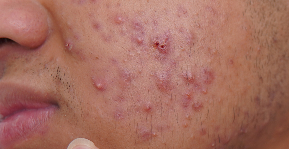 Acne Pimples 1 - Anova Skin Clinic