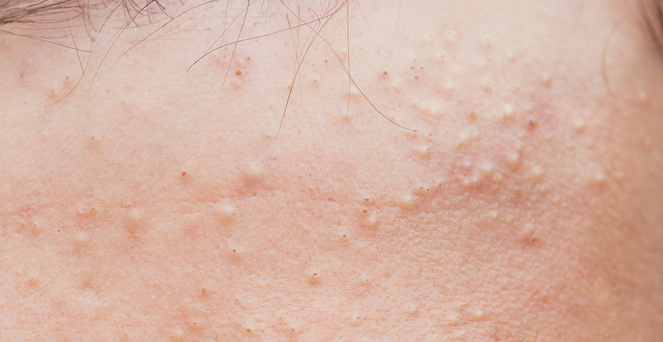 Acne Whiteheads 1 - Anova Skin Clinic