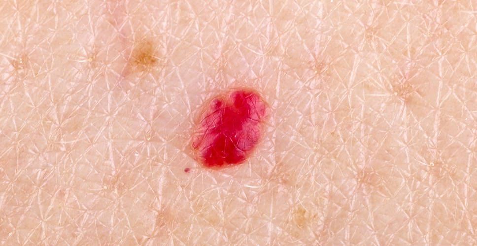 Cherry angiomas - benign skin lesions