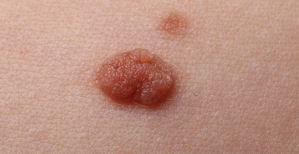 Moles - benign skin lesions