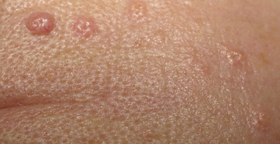 Sebaceous hyperplasia - benign skin lesions