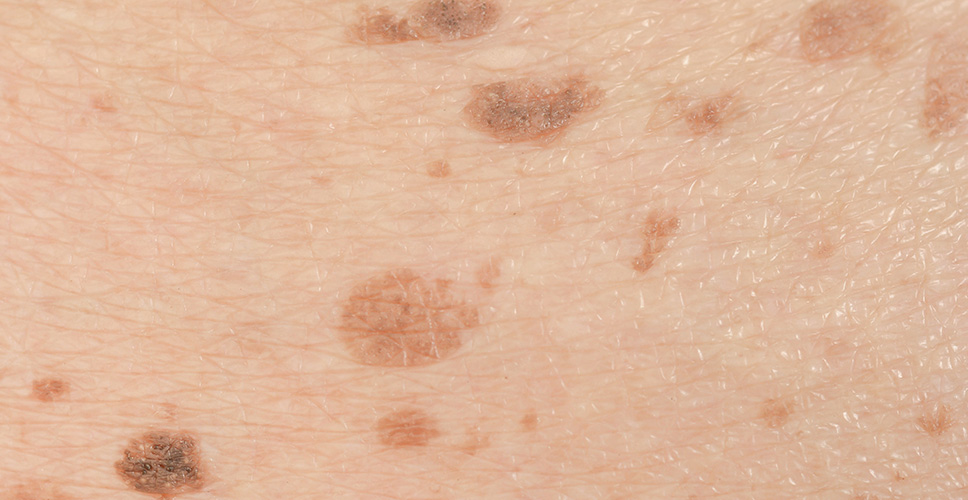 Seborrhoeic keratosis - benign skin lesions