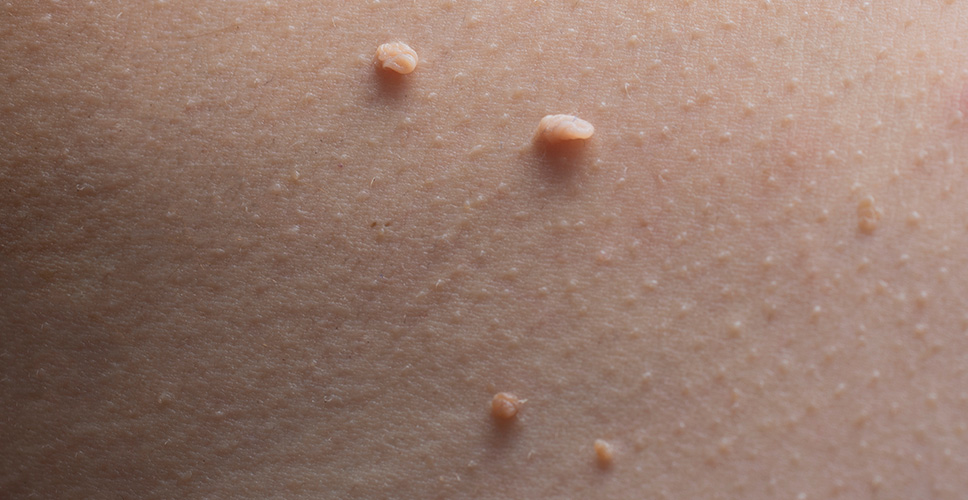 Skin tags - benign skin lesions