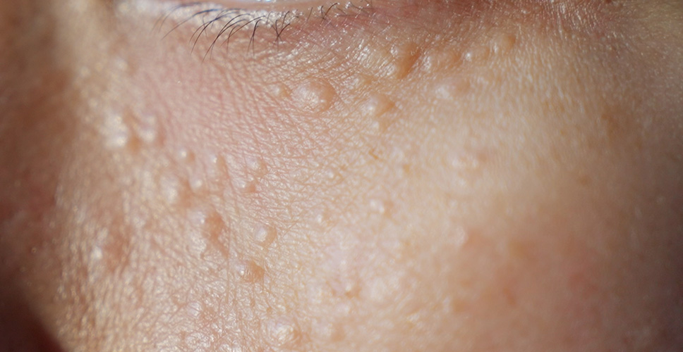 Syringomas - benign skin lesions