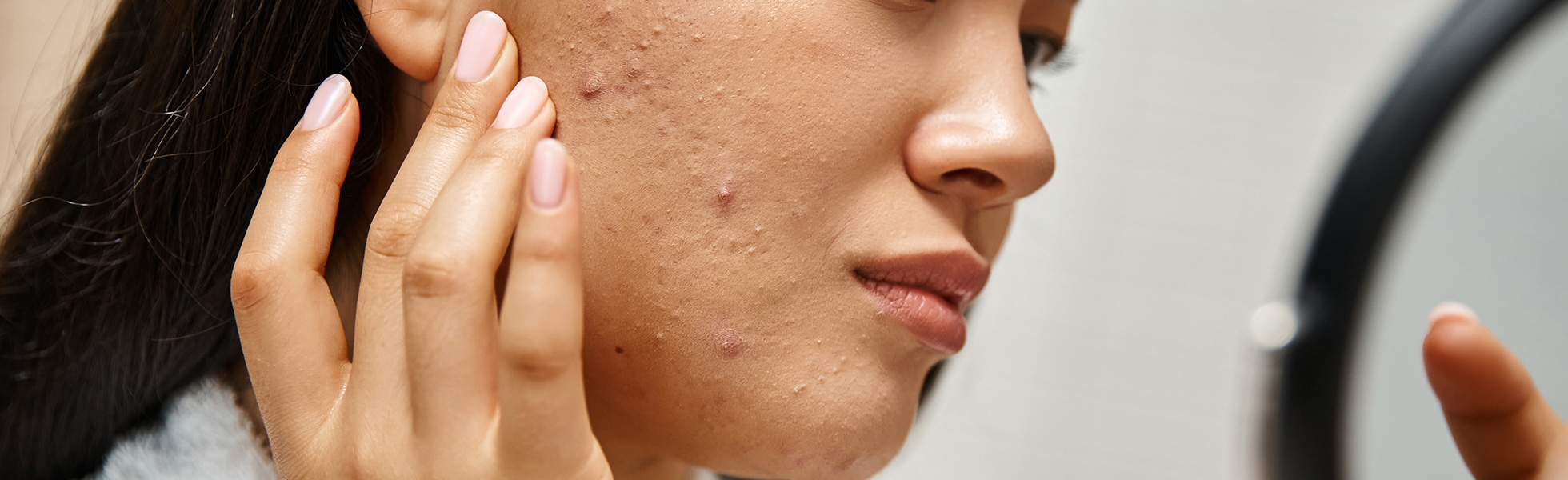 Acne