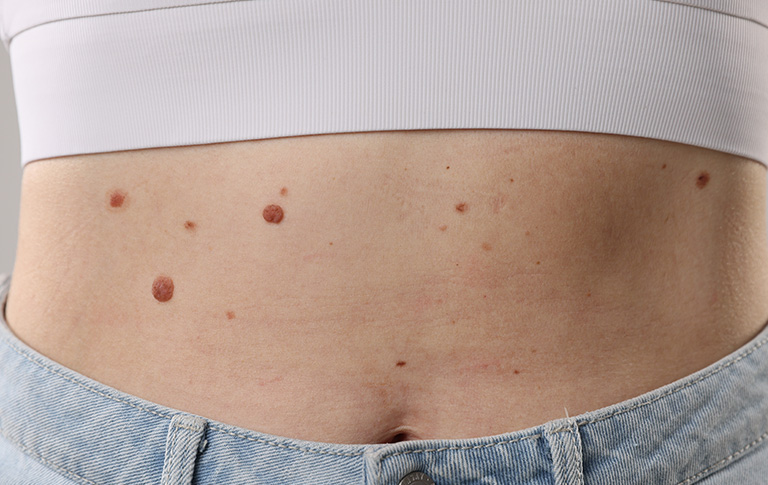 Benign Skin Lesions
