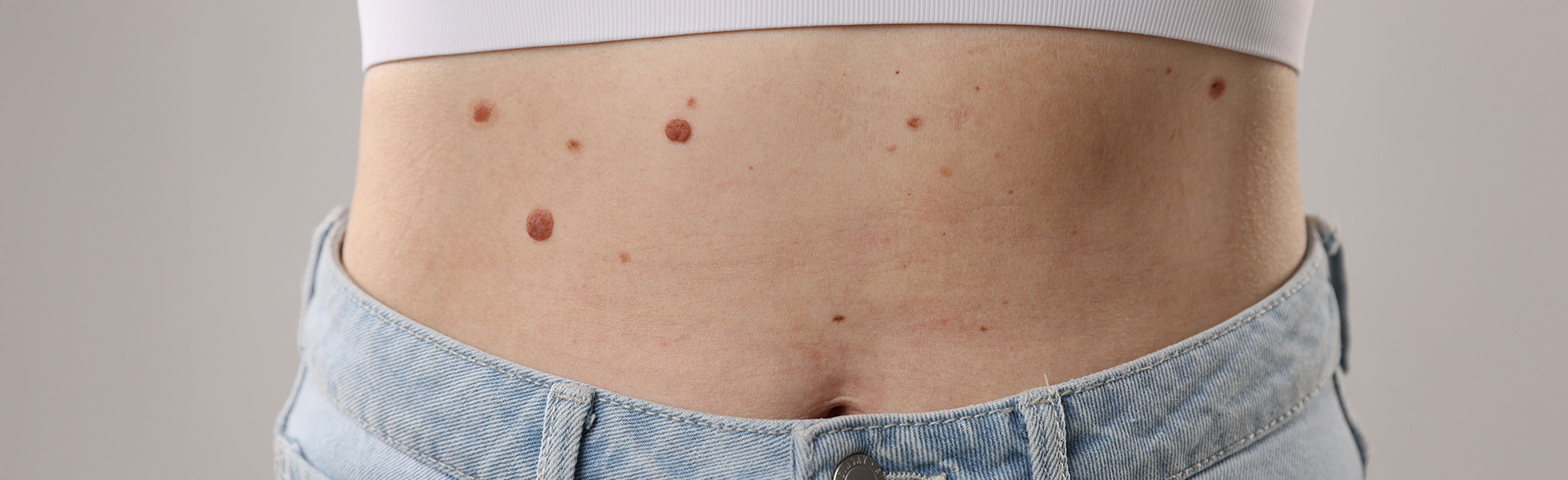 Benign Skin Lesions