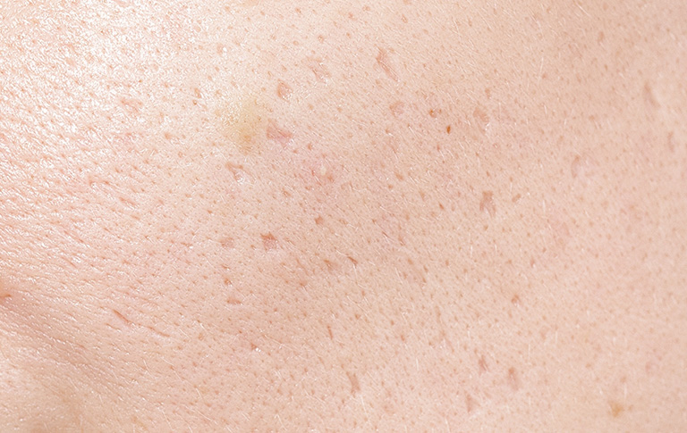 Scarring