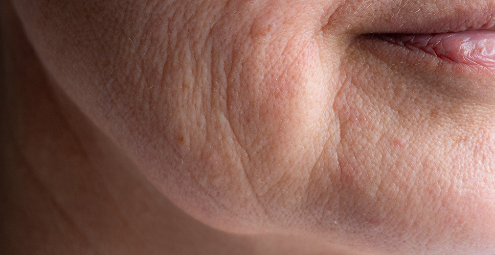 Concern Skin Sagging Jowls 1 - Anova Skin Clinic