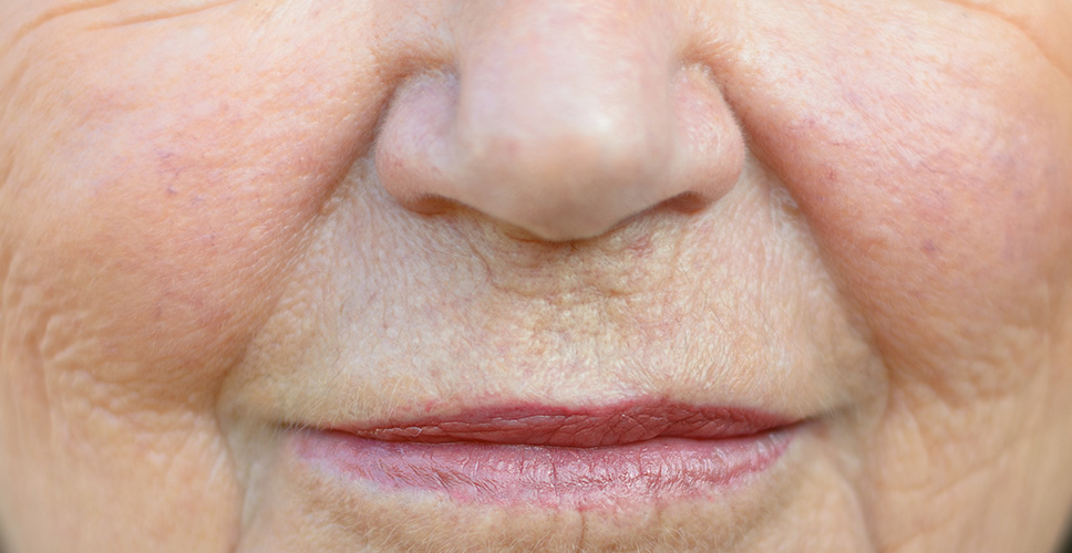 Concern Skin Sagging Nasolabial 1 - Anova Skin Clinic