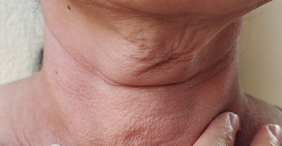 Concern Skin Sagging Neck Laxity 1 - Anova Skin Clinic