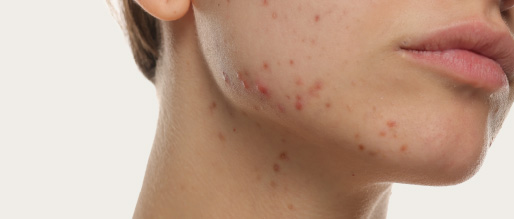 Acne