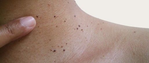 Benign Skin Lesions