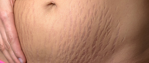 Concerns Body Stretch Mark - Anova Skin Clinic