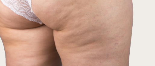 Concerns Body - Anova Skin Clinic