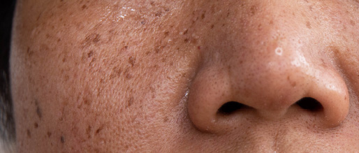 Hyperpigmentation