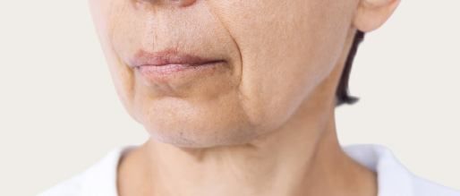 Skin Sagging & Laxity