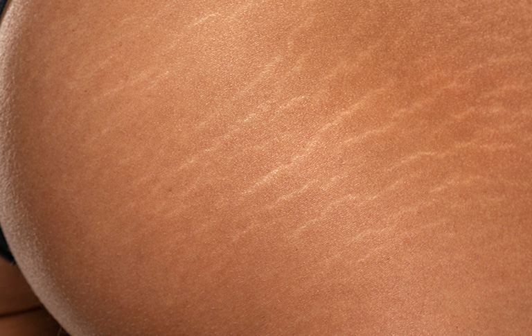 Stretch Marks