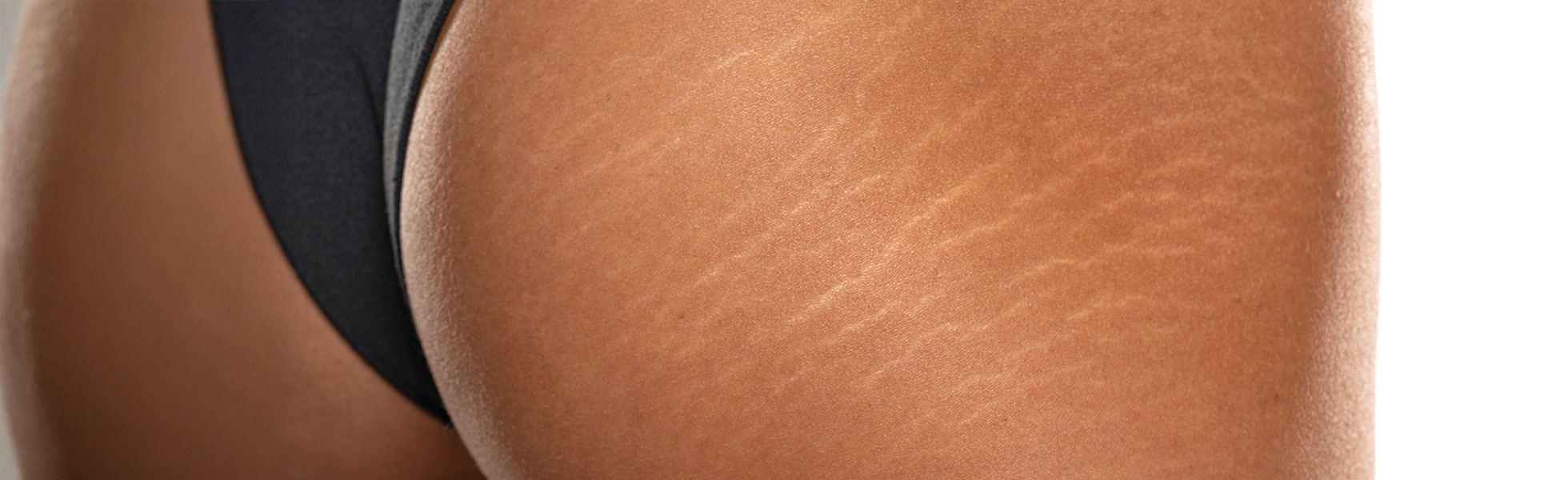Stretch Marks
