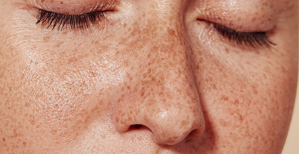 Forms Freckles 1 - Anova Skin Clinic