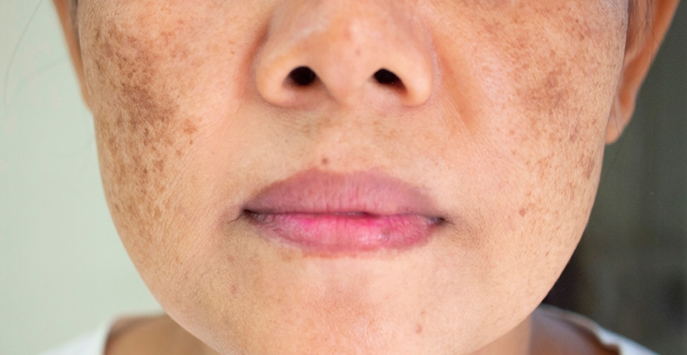Forms Melasma 1 - Anova Skin Clinic