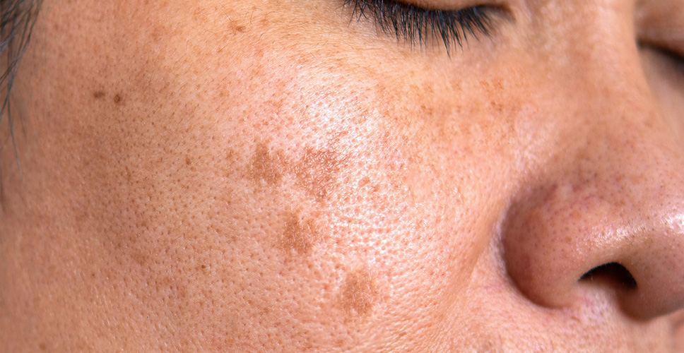 Forms Sunspots 1 - Anova Skin Clinic