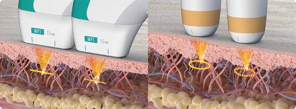 HIFU Mechanism - Anova Skin Clinic