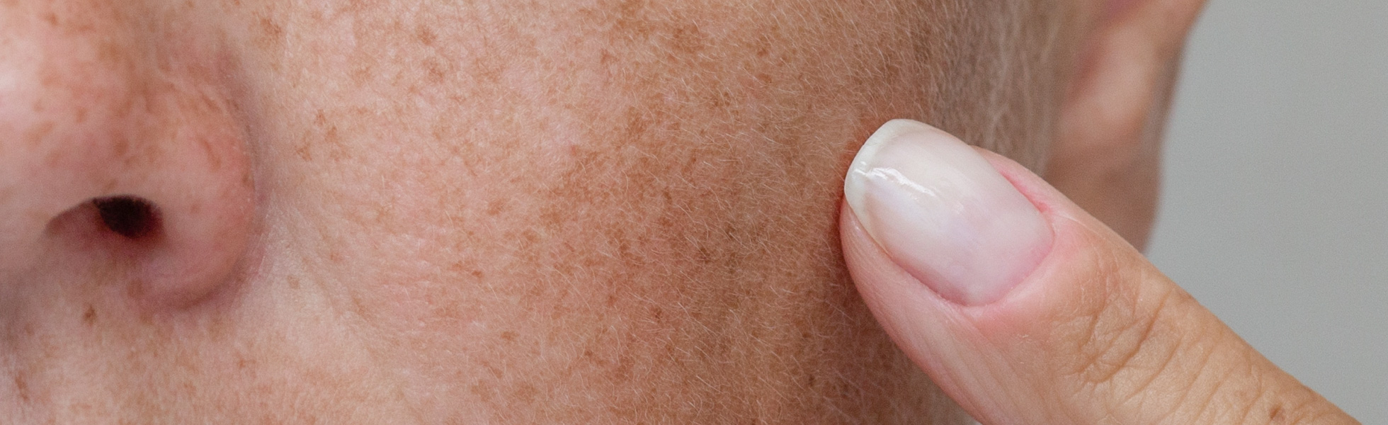 Hyperpigmentation