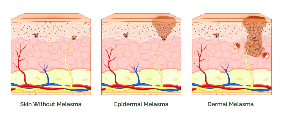 Hyperpigmentation skin diagram showing melasma types