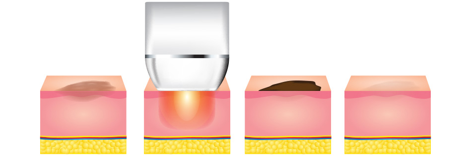 IPL Rejuvenation Pigmentation Sun Damage 1 - Anova Skin Clinic