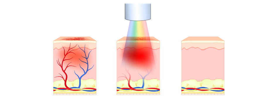 IPL Rejuvenation Redness Vascular Lesions 2 - Anova Skin Clinic