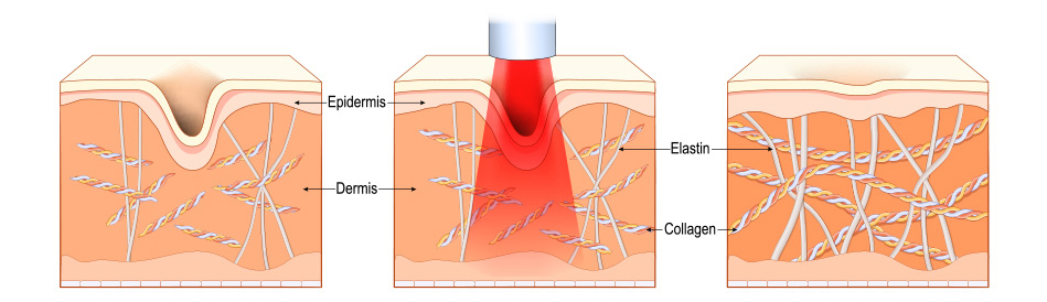 Nd Yag Laser Rejuvenation 2 - Anova Skin Clinic