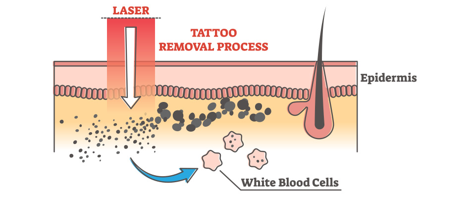 Nd Yag Laser Tattoo Removal - Anova Skin Clinic