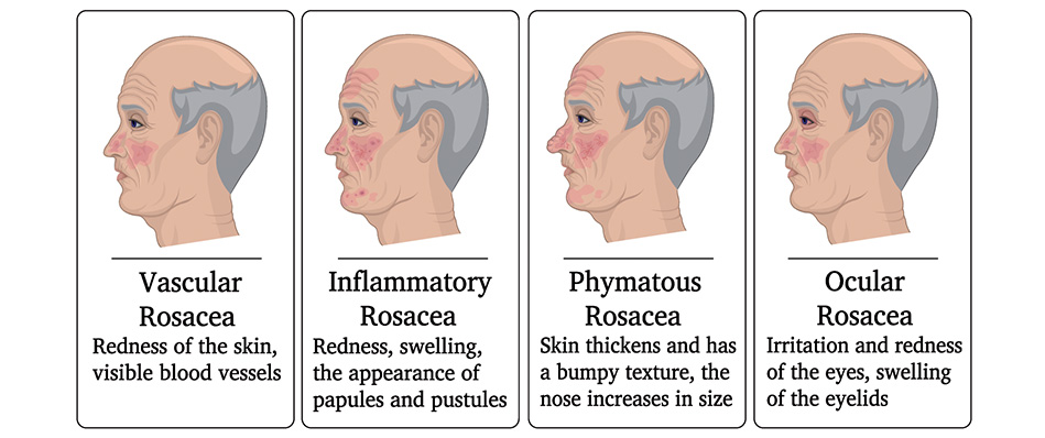 Rosacea subtypes diagram