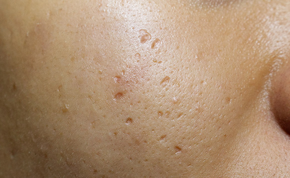 Depressed acne scars on skin