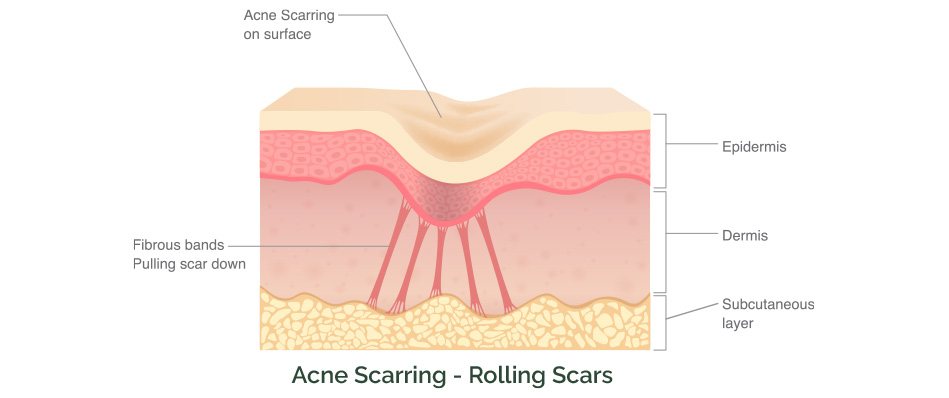 Scarring diagram types of scars