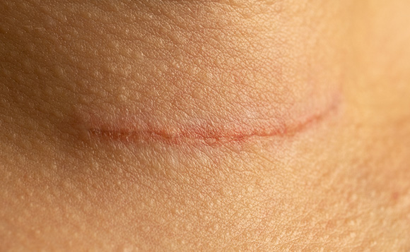 Flat scars on skin
