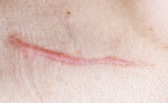 Raised scars on skin