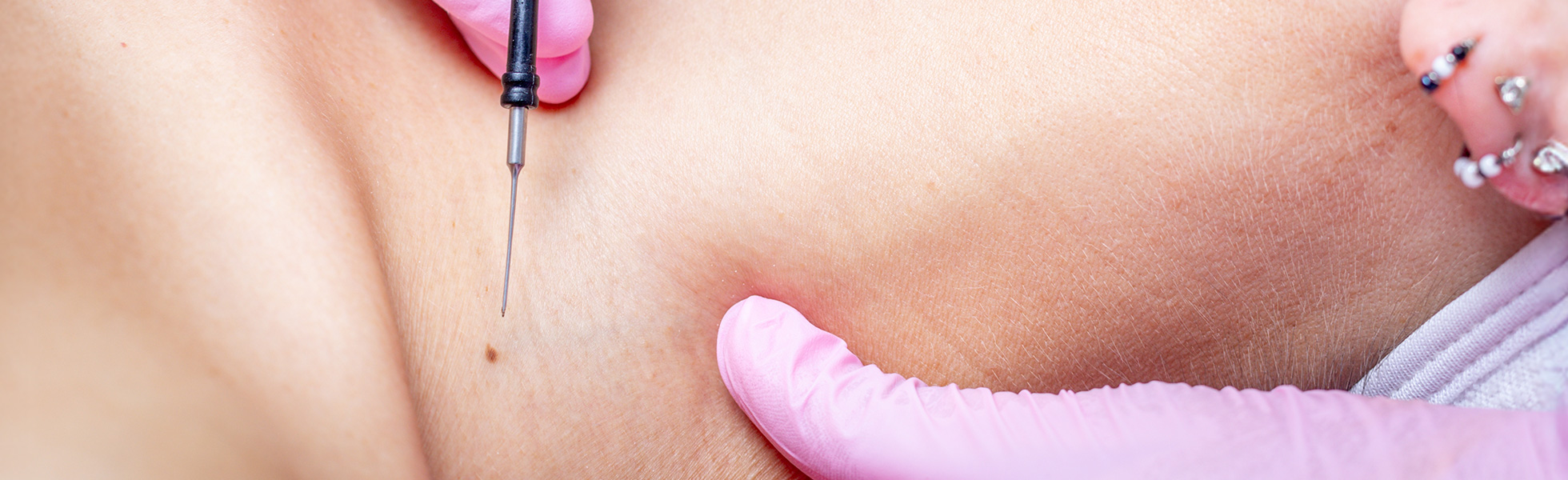 Benign Lesion Removal – Diathermy