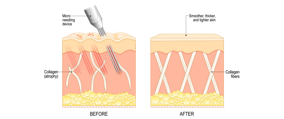 Service Microneedling Machenism - Anova Skin Clinic