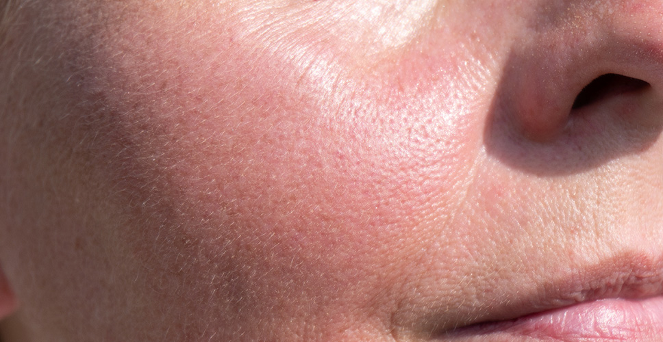 Skin Redness Diffuse 1 - Anova Skin Clinic