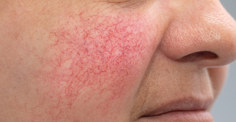 Skin Redness Dilated Capillaries 1 1 - Anova Skin Clinic