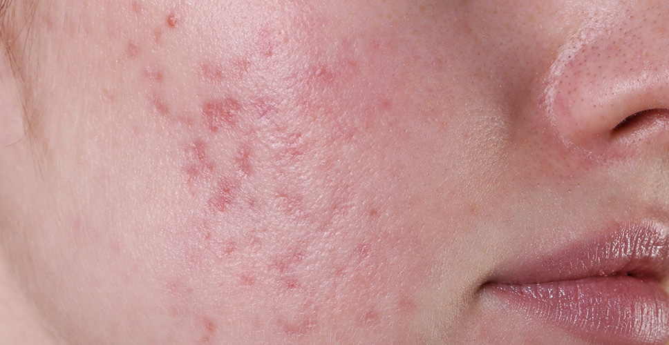 Skin Redness Post Injury 1 - Anova Skin Clinic