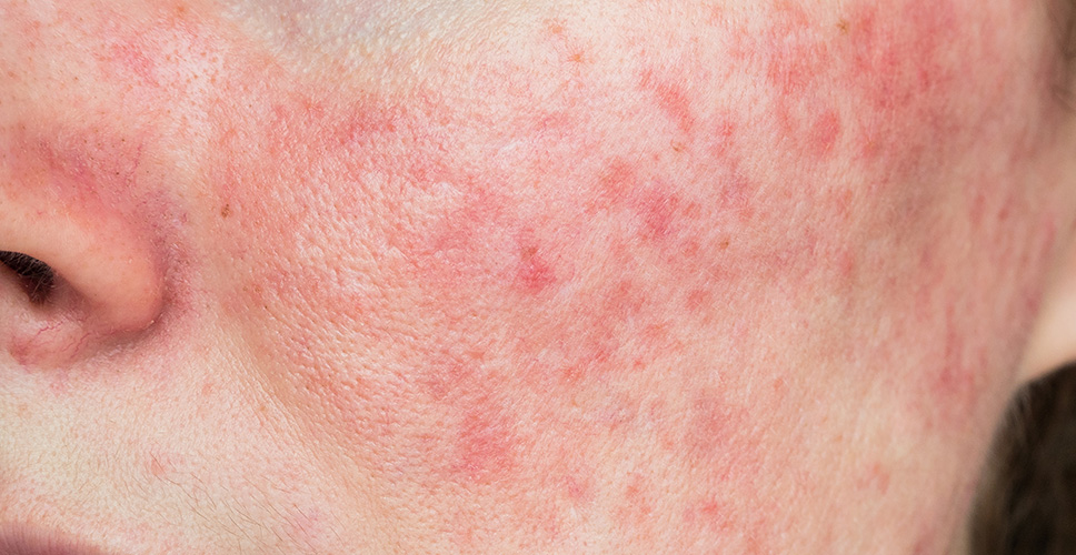 Skin Redness Rosacea 1 - Anova Skin Clinic