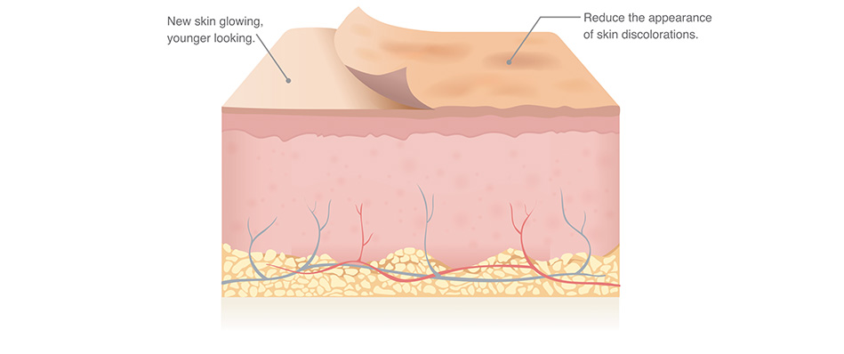 Alpha hydroxy acid skin treatment
