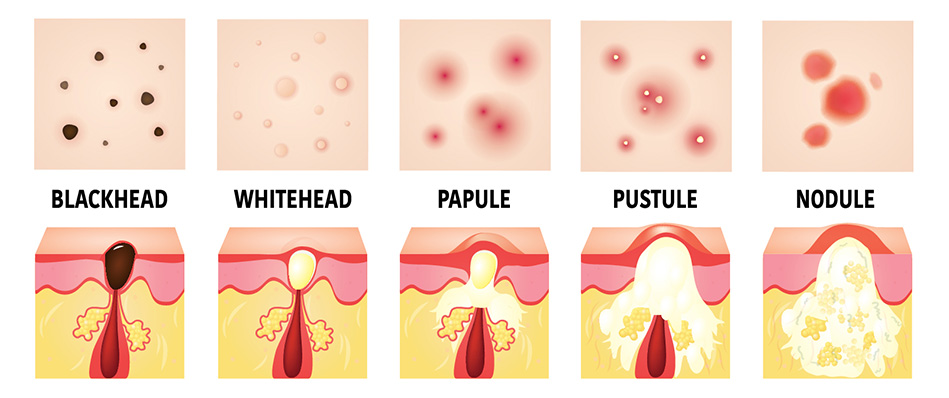 Types of acne lesions diagram