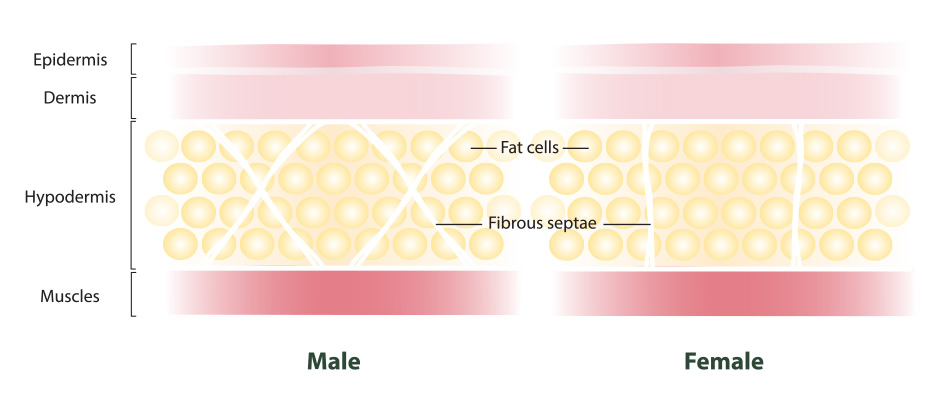 Cellulite - Anova Skin Clinic