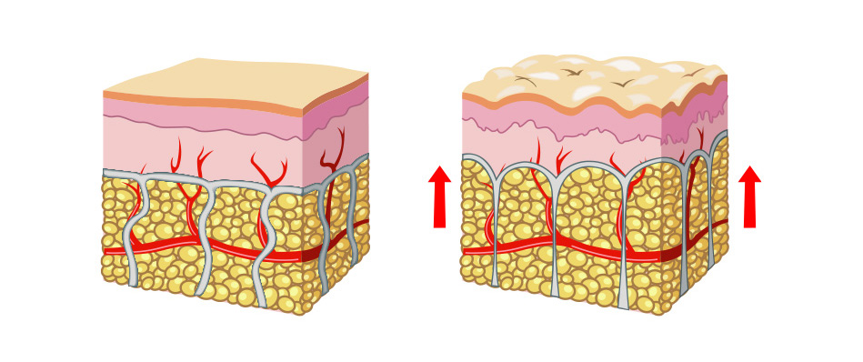 Stretch Mark Image - Anova Skin Clinic